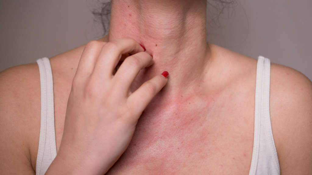 Dermatite atópica e o papel do alergista para o diagnóstico e tratamento