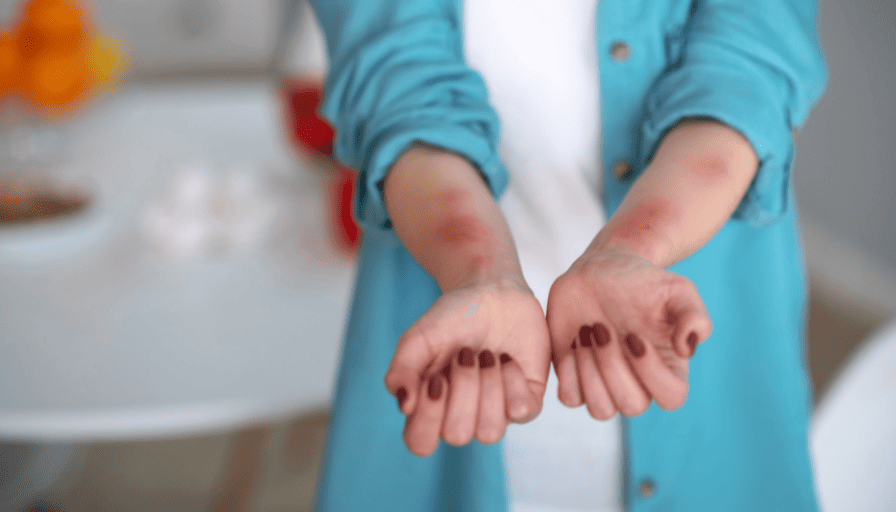 Entendendo a Urticária Crônica